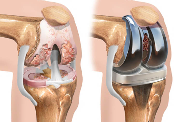 Diz Protezi Cerrahisi