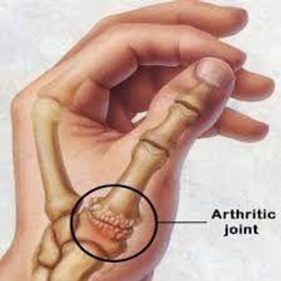 Başparmak Kireçlenmesi