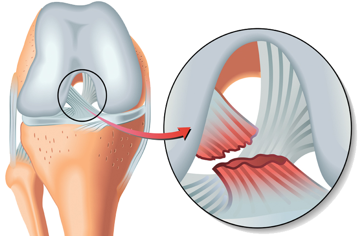 Menisküs - Ön Çapraz Bağ Yırtıkları